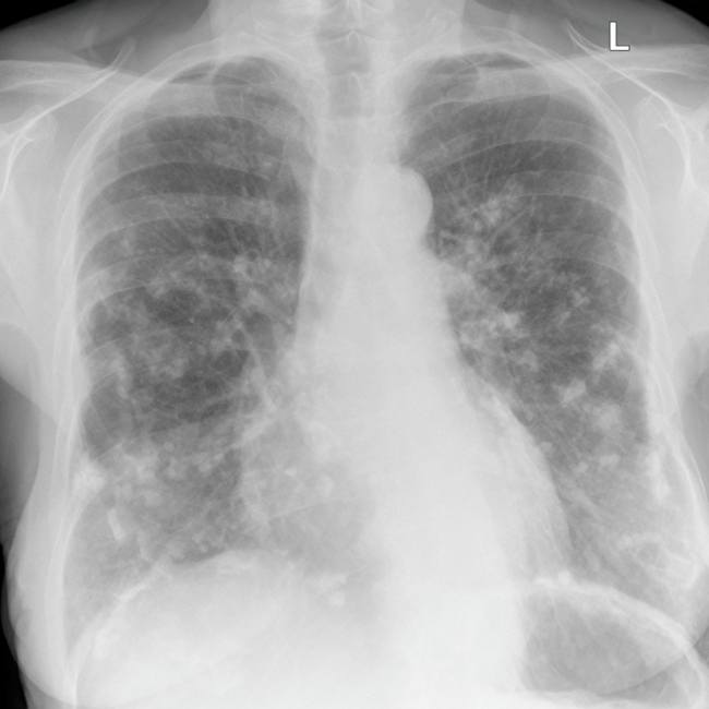 Asbestos-related-pleural-plaques-on-chest-X-Ray - Mobile